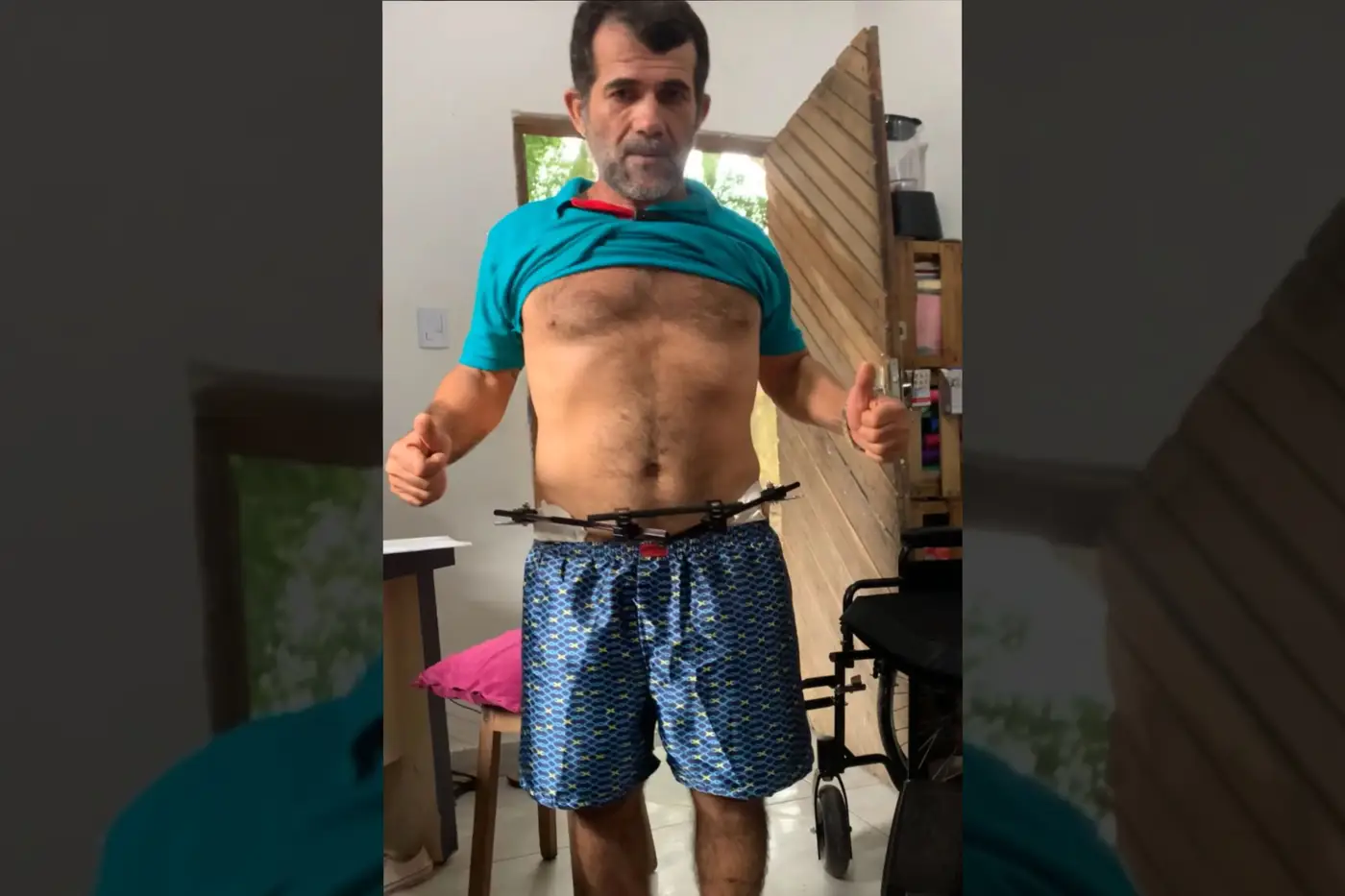 Gilvamir Bezerra segue se recuperando em casa, e já consegue dá os primeiros passos após a cirurgia