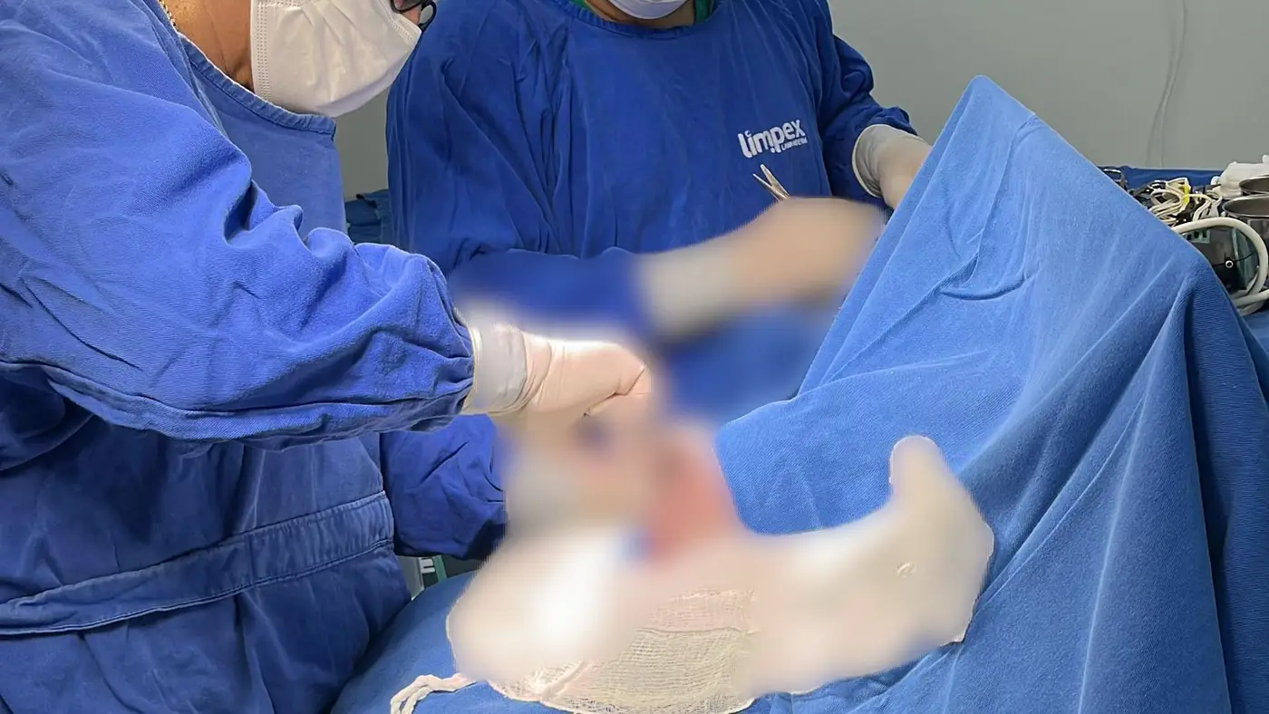A trepanação foi realizada com o apoio da equipe do Hospital de Clínicas Dr. Alberto Lima, em Macapá