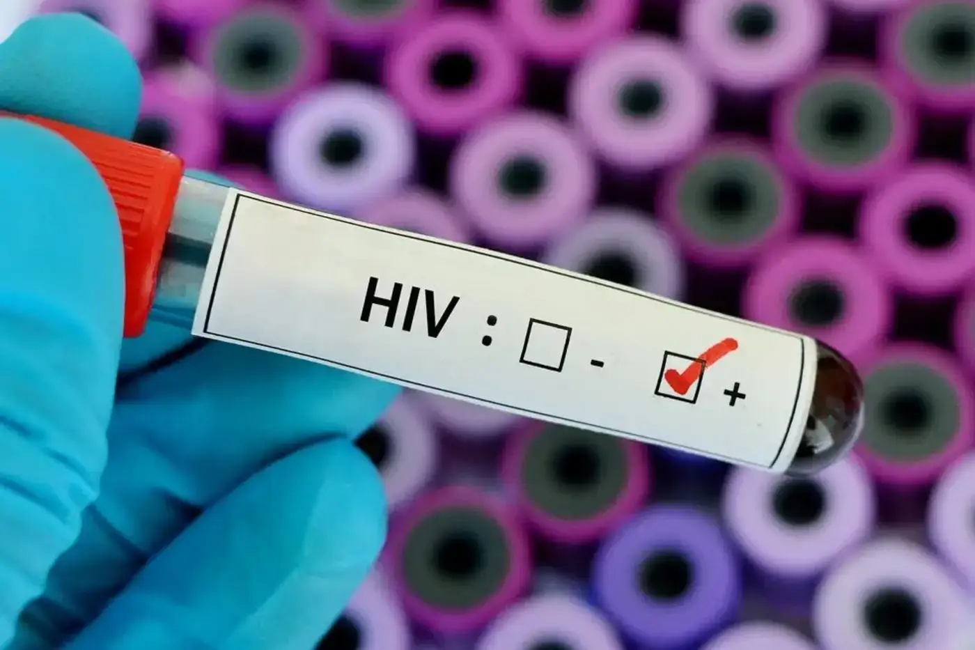 Até 1º de dezembro, foram registrados 319 novos casos de HIV no Amapá